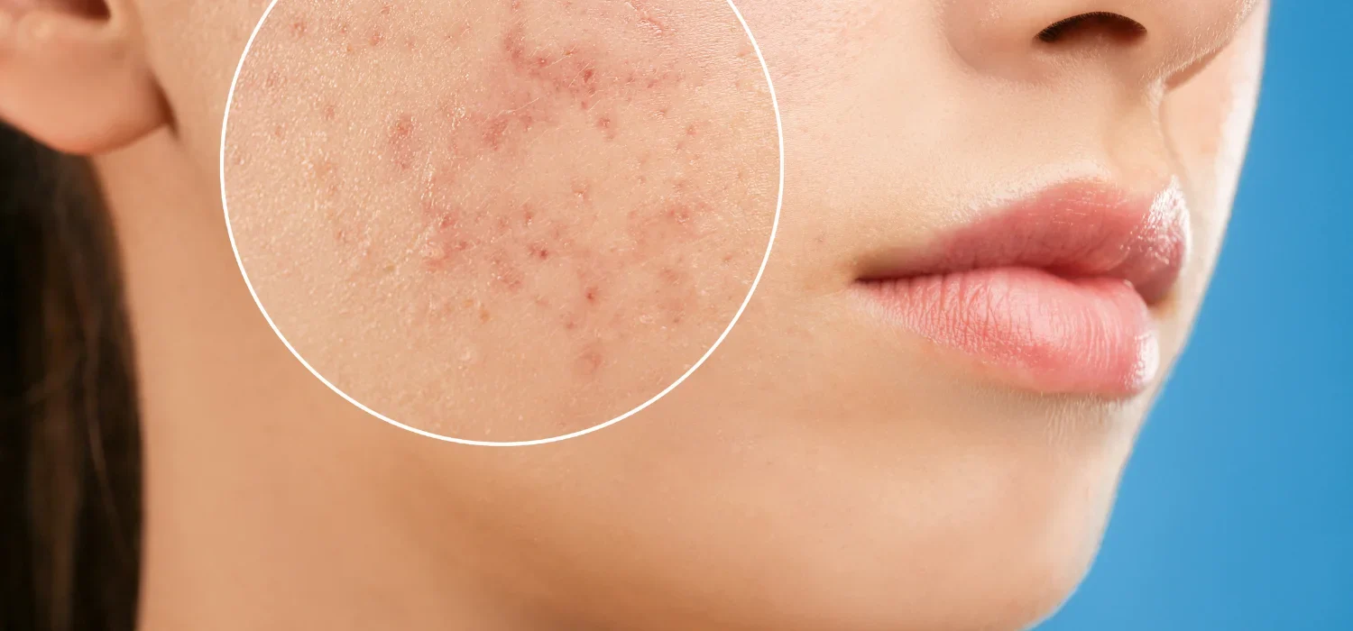 Acne Treatment Newport Beach