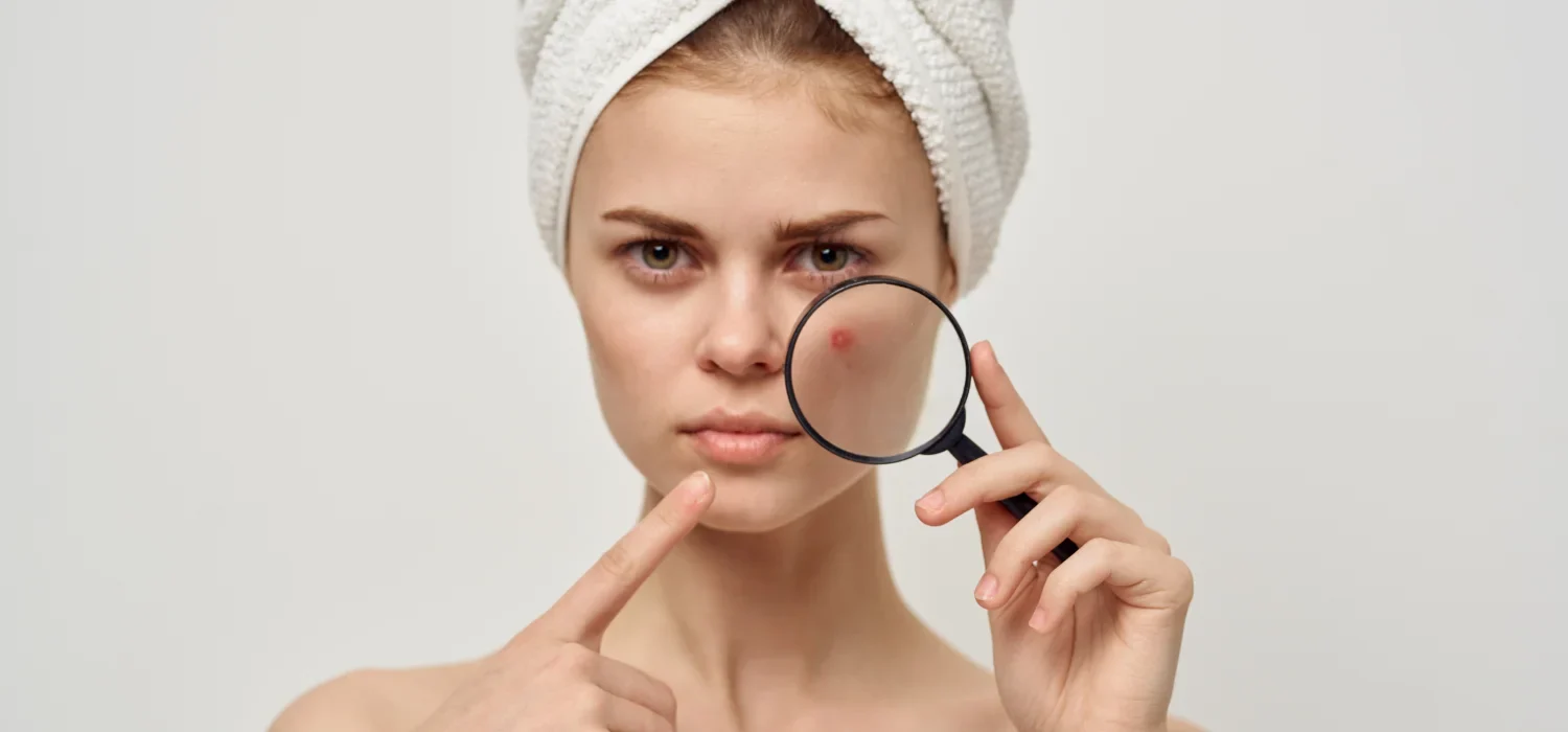 Acne Treatment Newport Beach Achieving Clear Skin 3